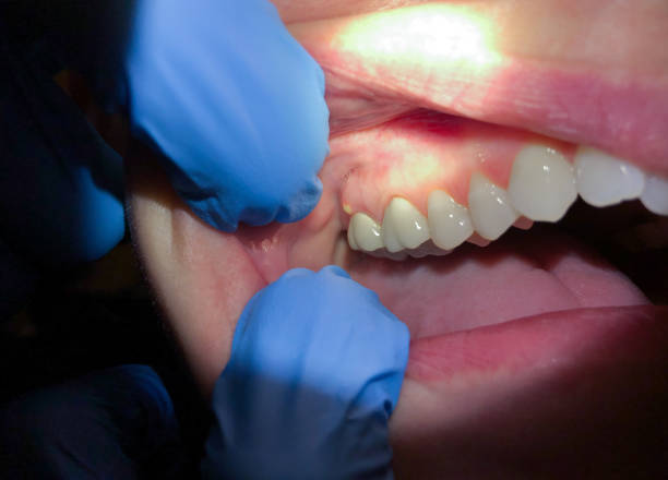 Best Emergency Dental Care for Abscessed Tooth in Beverly Hills, CA